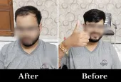Best Hair Patch in Lucknow | Adam’s Secret