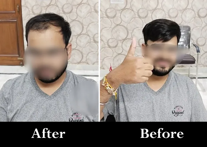 Best Hair Patch in Lucknow | Adam’s Secret