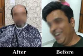 Best Hair Patch in Lucknow | Adam’s Secret