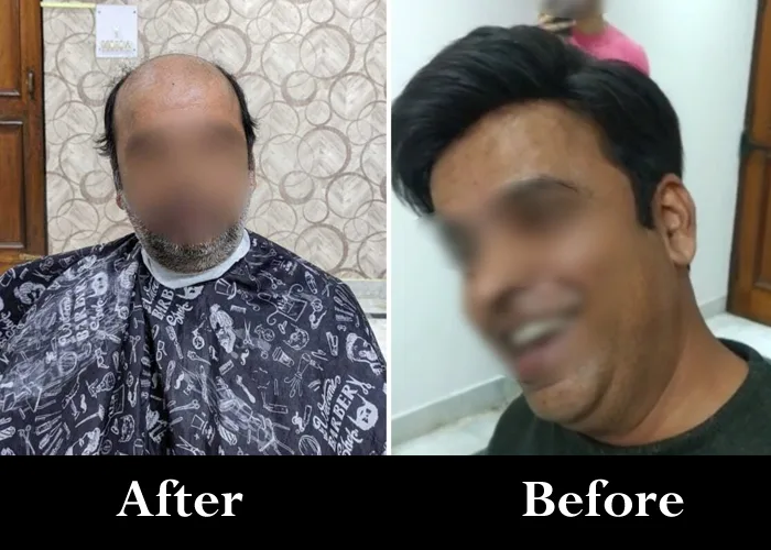 Best Hair Patch in Lucknow | Adam’s Secret